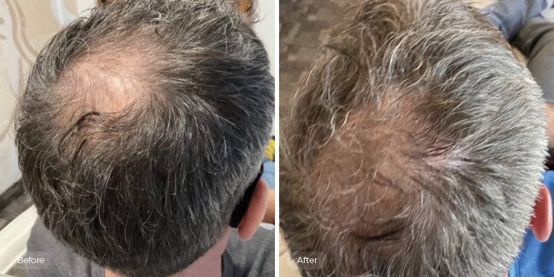 Reclaim Your Luscious Locks with PRP Hair Treatment at Visage Medical Aesthetics Regina